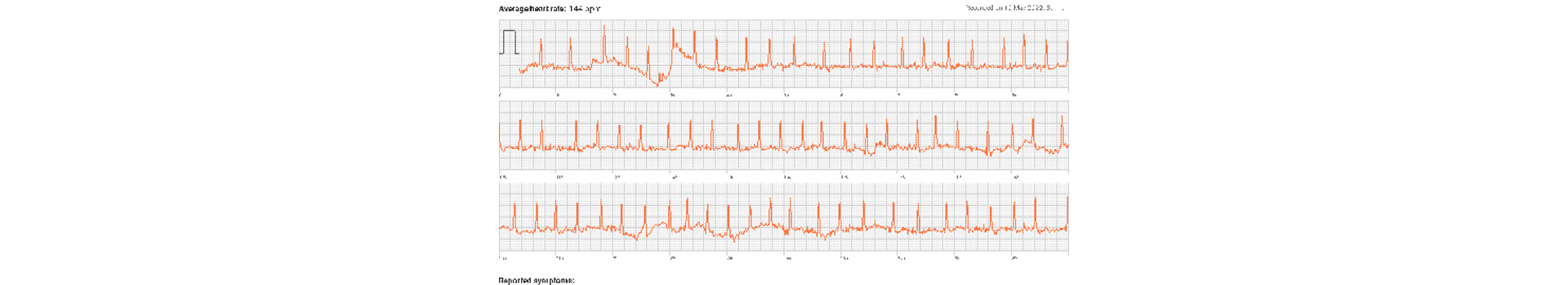 Φορετές συσκευές (wearables) και κολπική μαρμαρυγή