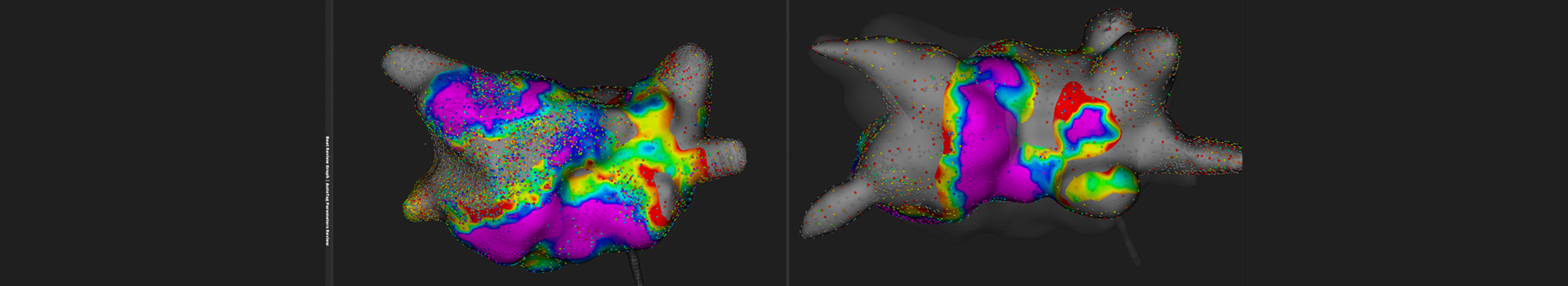 Κατάλυση κολπικής μαρμαρυγής σε ασθενείς με καρδιακή ανεπάρκεια