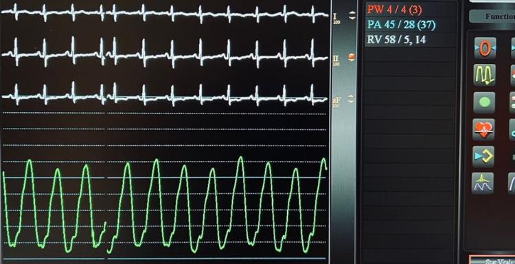 Στεφανιαία νόσος