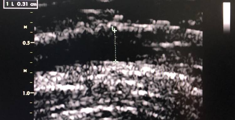 στεφανιαία νόσος