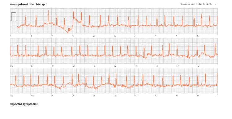 κολπική μαρμαρυγή