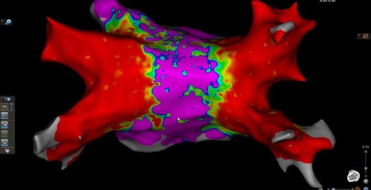 κολπική μαρμαρυγή