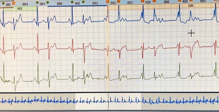 Ηλεκτρικά νοσήματα καρδιάς