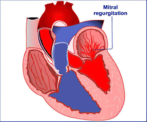 ανεπάρκεια μιτροειδούς βαλβίδας