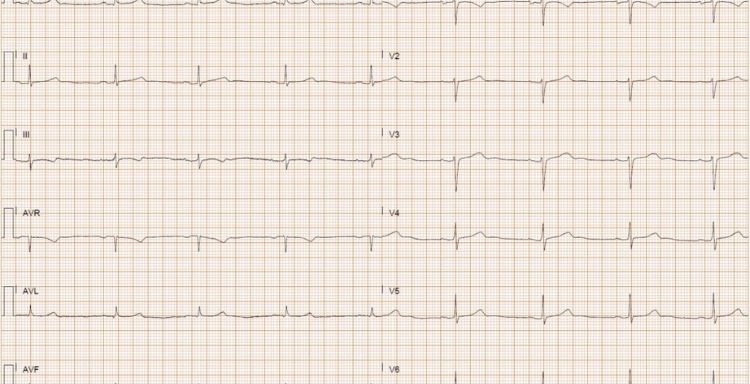 Ηλεκτροκαρδιογράφημα