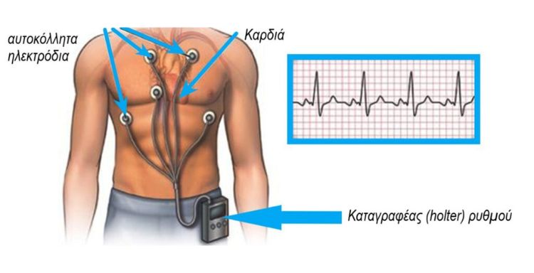 Holter καρδιακού ρυθμού